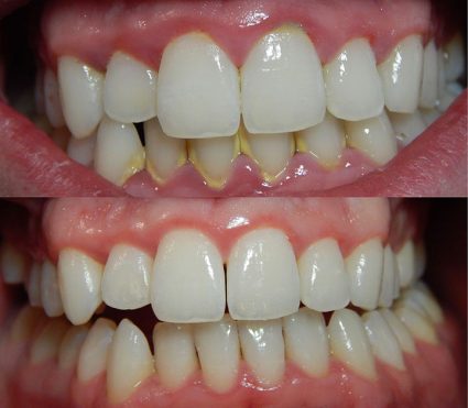 Răng bị vàng do đâu? cách để răng trắng đẹp trở lại?