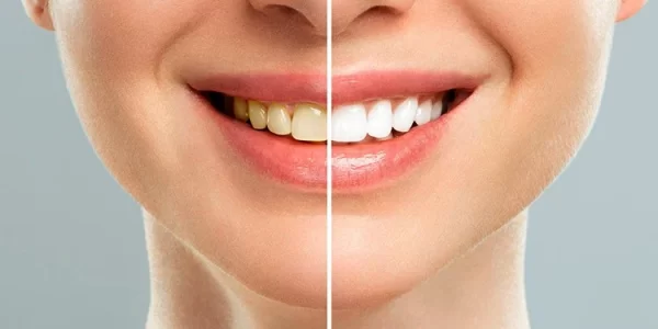 Răng bị vàng do đâu? cách để răng trắng đẹp trở lại?