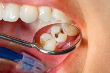 Bọc răng sứ là phương pháp giải quyết tình trạng răng bị hư hỏng