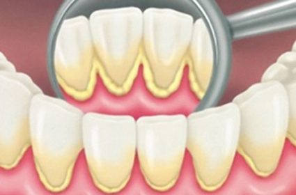 Phân loại vôi răng trước khi cạo vôi răng