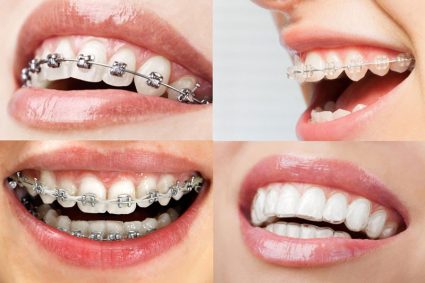 Các phương pháp chỉnh nha (niềng răng) hiện nay