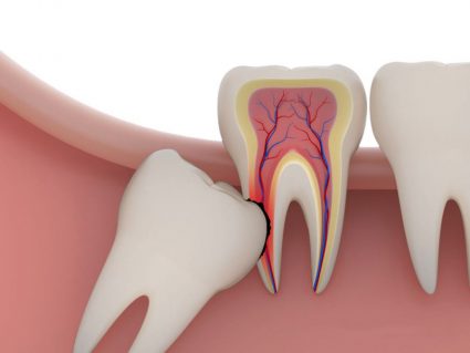 Răng khôn mọc lệch gây ảnh hưởng đến răng bên cạnh