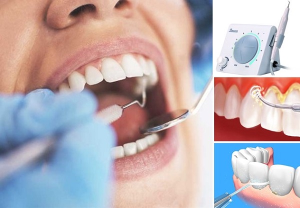 Chăm sóc răng sau khi cạo vôi răng, đánh bóng răng