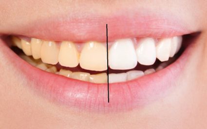 Tẩy trắng răng giúp tăng tính thẩm mỹ cho răng