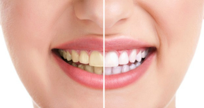 Hãy cạo vôi răng định kỳ để đảm bảo tốt các vấn đề vệ sinh răng miệng
