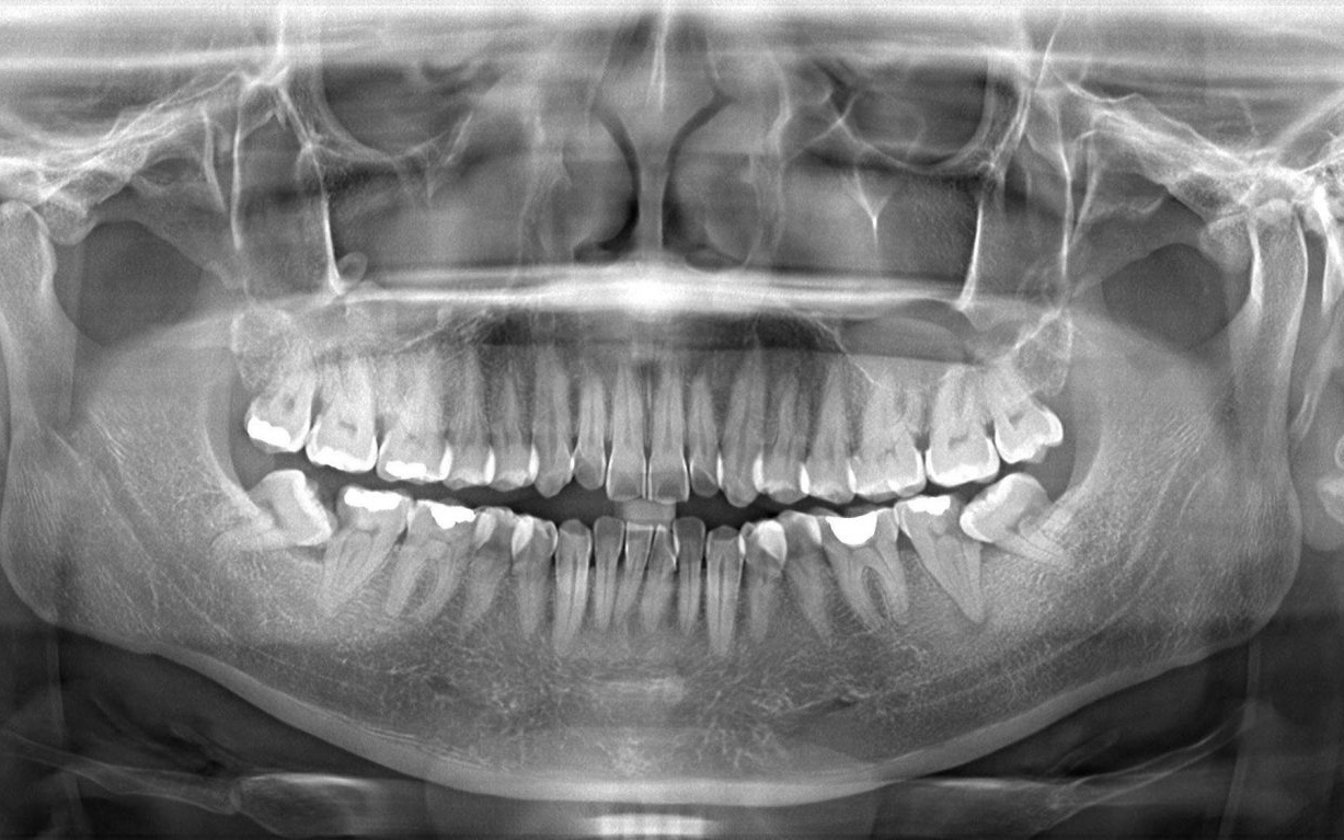 Chụp X - Quang giúp quá trình chuẩn đoán việc trám răng chuẩn xác hơn