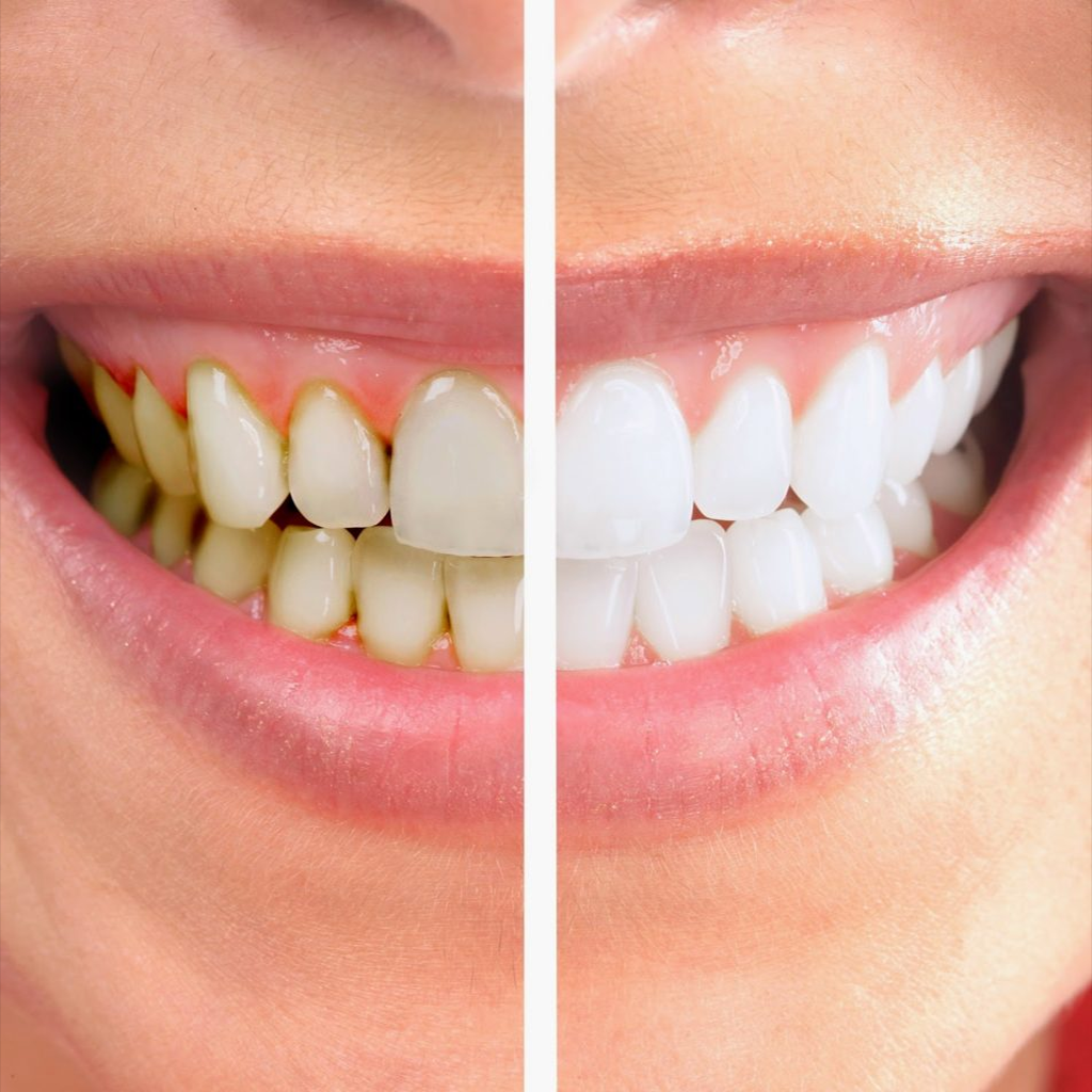 Lấy cao răng không làm trắng răng nhưng giúp răng sáng hơn nhiều
