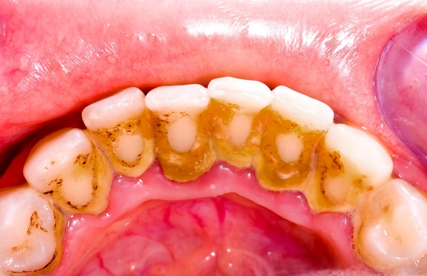 Cao răng là gì? Cạo vôi răng có đau không?