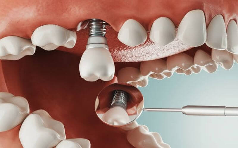 Dịch Vụ Implant là gì? Phương pháp có gây ảnh hưởng đến sức khoẻ hay không?