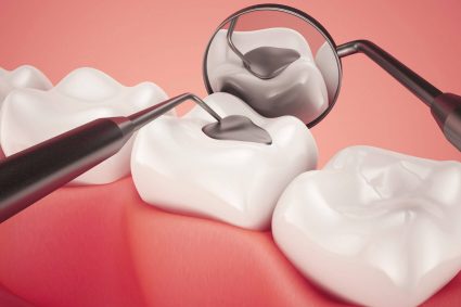 Hiểu thế nào về trám răng thẩm mỹ?