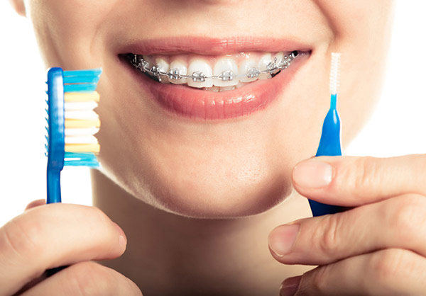 Dù là trước và sau khi niềng thì bạn đều cần chăm sóc vệ sinh răng thật kỹ 