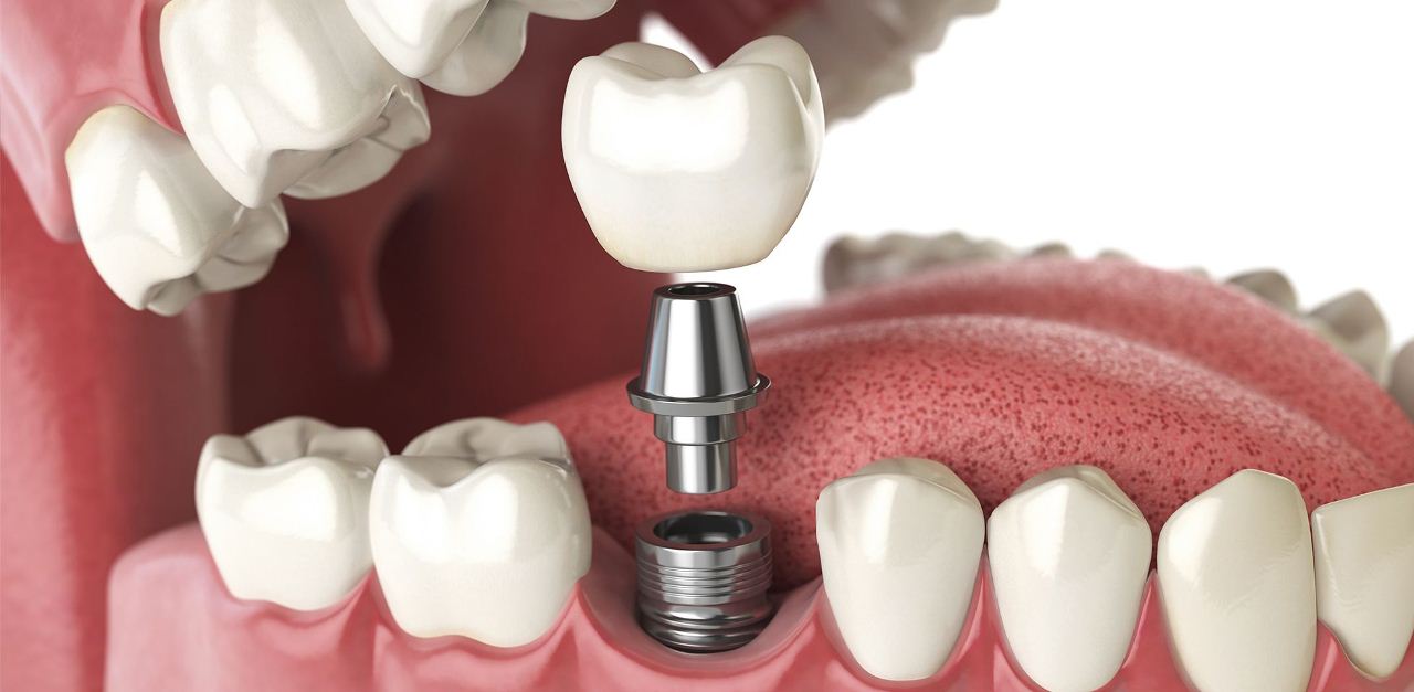 Lựa chọn dịch vụ Implant bạn sẽ sở hữu hàm răng trông thẩm mỹ và tuổi thọ cao 