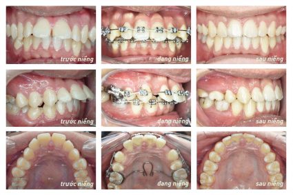 Trước và sau khi niềng răng chúng ta cần lưu ý những vấn đề gì?