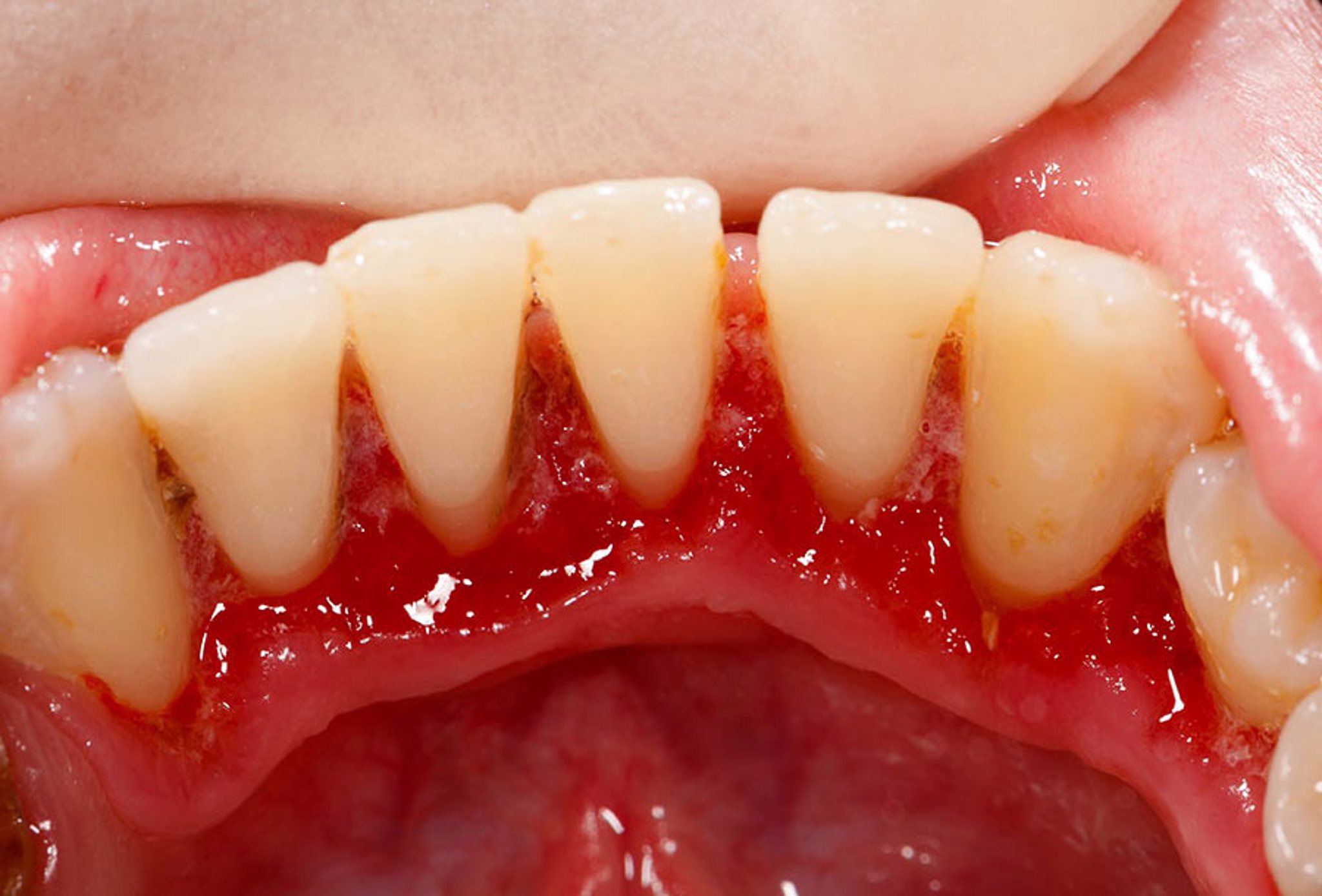 Răng khôn có nên nhổ không? Nếu không có thể dẫn đến tình trạng viêm lợi/ nướu