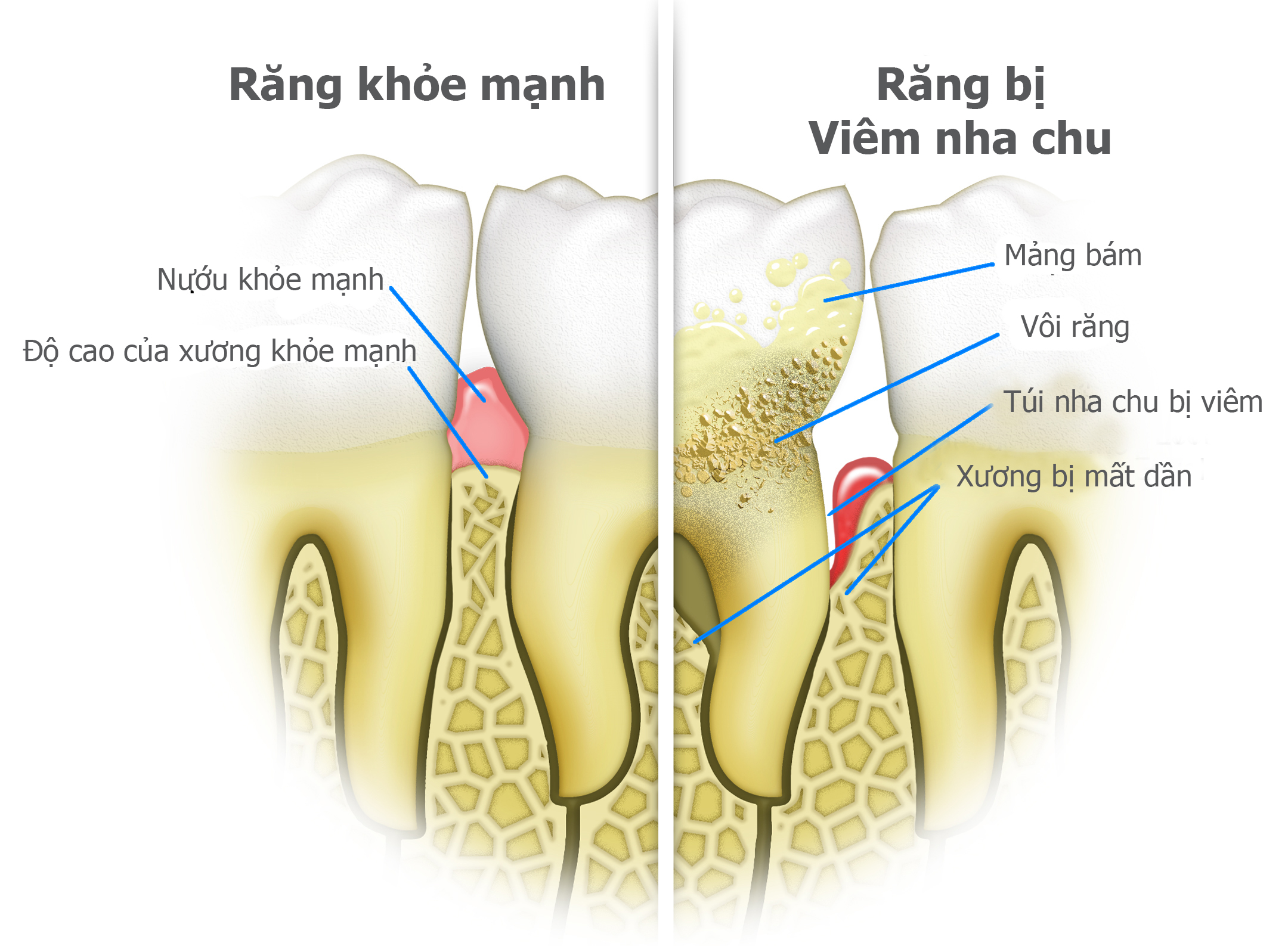 Hình ảnh phân biệt răng khoẻ mạnh và viêm nha chu