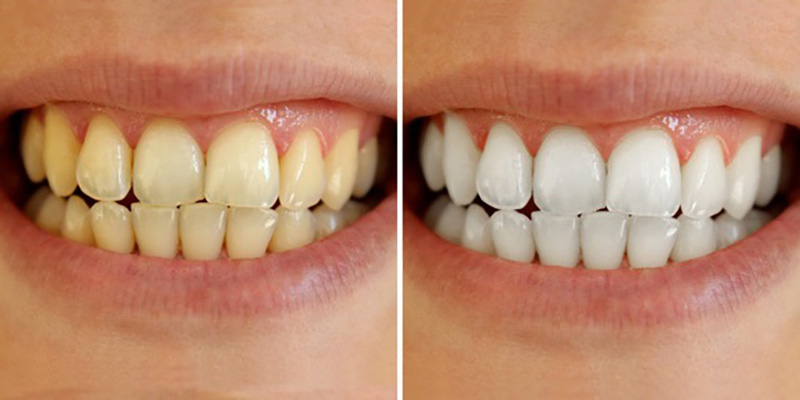 Vậy tẩy trắng răng có hại không? Có làm ảnh hưởng đến men răng?