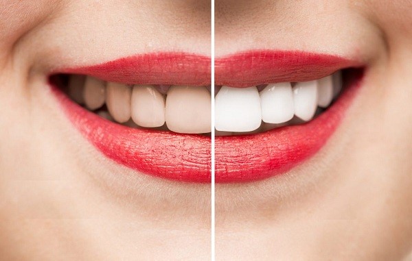 Cùng tìm hiểu xem tẩy trắng răng có hại không 