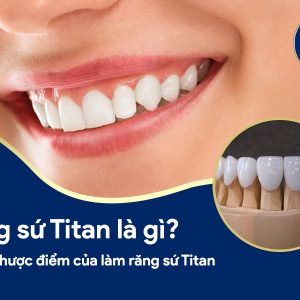 Răng sứ Titan là gì? Ưu và nhược điểm của làm răng sứ Titan