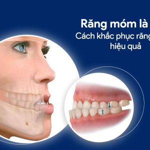 Răng móm là gì? Cách khắc phục răng móm hiệu quả