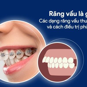 Răng vẩu là gì? Các dạng răng vẩu thường gặp và cách điều trị phù hợp