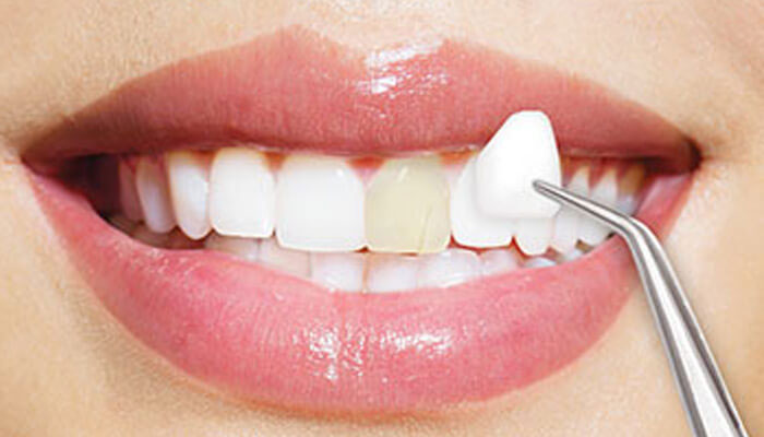dán răng sứ là gì
