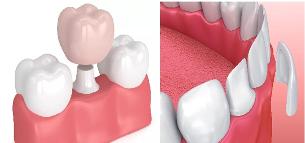 Nên bọc răng sứ hay dán Veneer? So sánh điểm giống và khác nhau