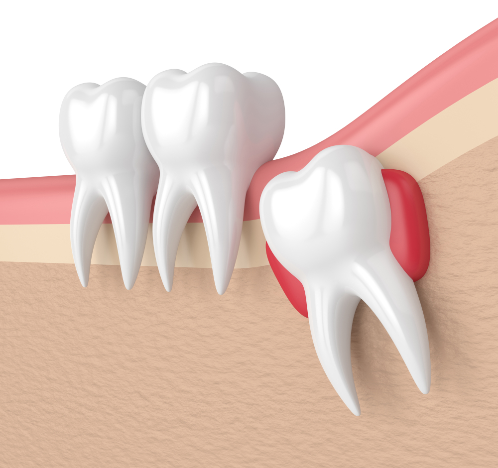 Dấu hiệu mọc răng khôn - Có nên nhổ răng khôn không?