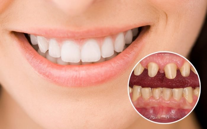 Răng sâu nên bọc sứ hay trám - Phương pháp nào tối ưu nhất
