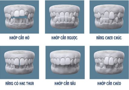 hình minh họa các tình trạng răng 