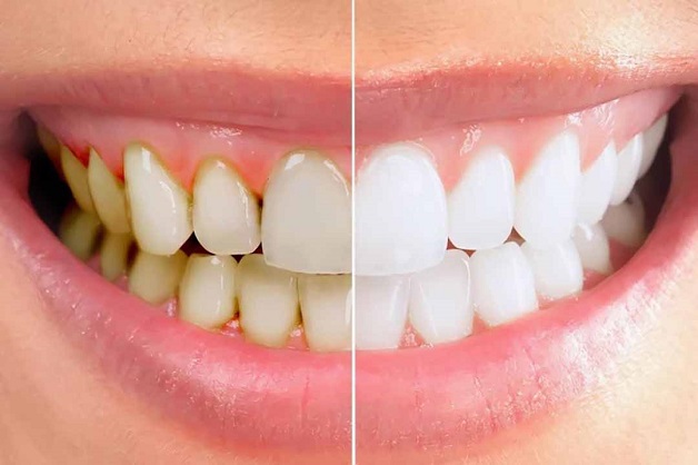 Cao răng hình thành thế nào, tác hại của cao răng là gì?