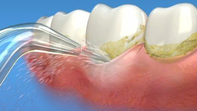 Cao răng hình thành thế nào, tác hại của cao răng là gì?