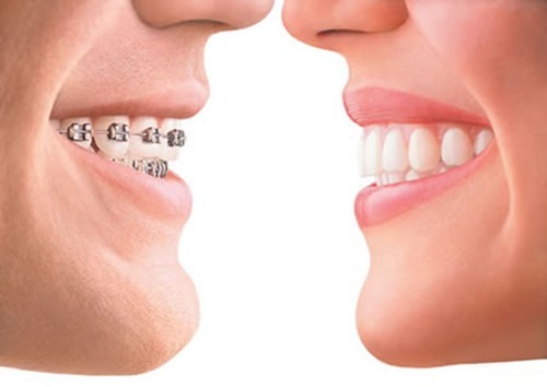 Răng hô là gì? Phương pháp điều trị răng hô hiệu quả
