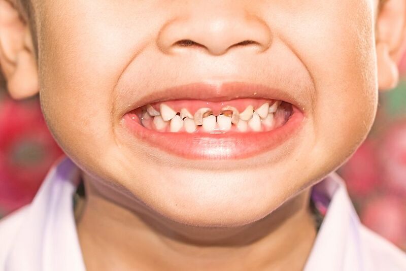 Sâu răng ở trẻ em - Nguyên nhân, điều trị và cách phòng ngừa
