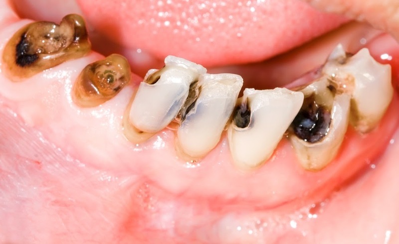 Sâu răng nha khoa quận 4