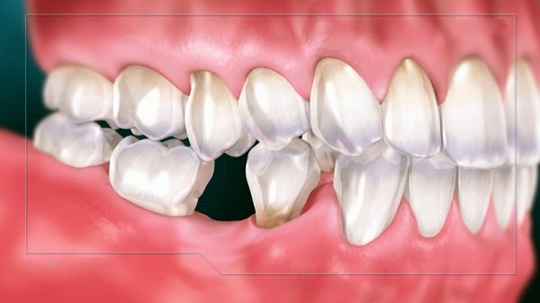 Mất răng hàm có ảnh hưởng gì không? Biện pháp khắc phục