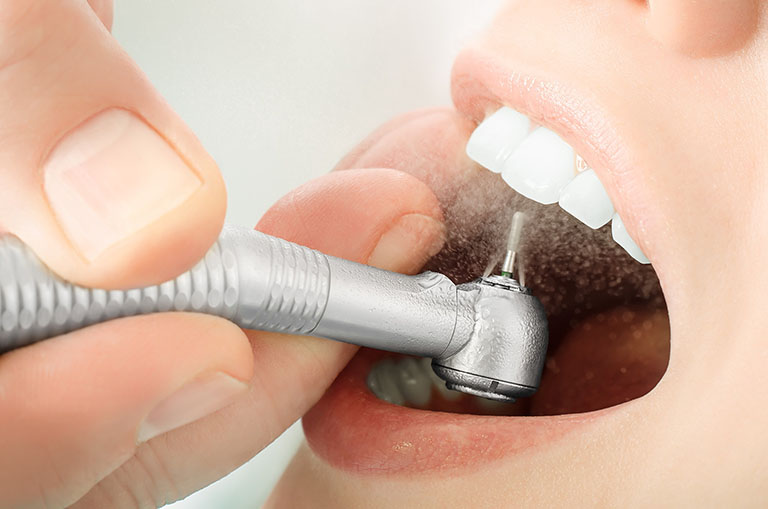 Trám răng là gì? Quy trình thực hiện trám răng đúng chuẩn