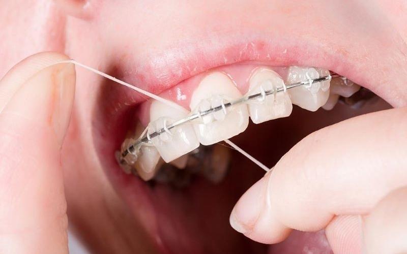 Cách dùng chỉ nha khoa cho người niềng răng 
