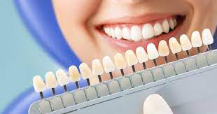 Tẩy trắng răng là gì ? 