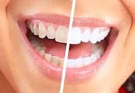 tẩy trắng răng có tốt không ?