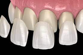 Những ai nên điều trị dán răng sứ Veneer 