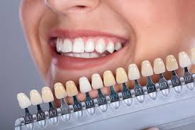 Các phương pháp tẩy trắng răng hiện nay 
