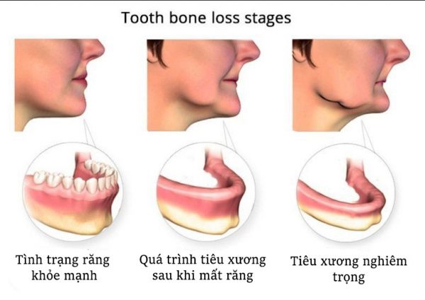 tiêu xương vì mất răng 
