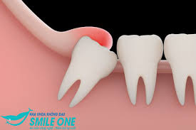 sưng và đỏ quanh răng khi răng bị viêm tủy 