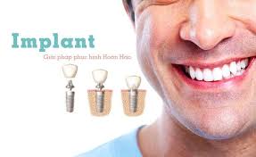 trồng răng implant Nha Khoa HAPPY