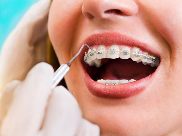 Niềng răng thẩm mỹ – Giải pháp mang lại nụ cười đẹp hoàn hảo