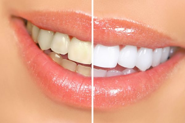 Tẩy trắng răng có hại không? Làm sao để tẩy trắng răng an toàn?