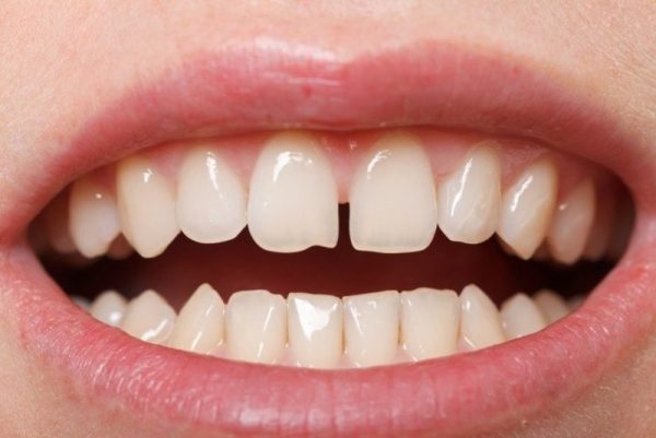 Vì sao răng thưa? Nguyên nhân và cách khắc phục