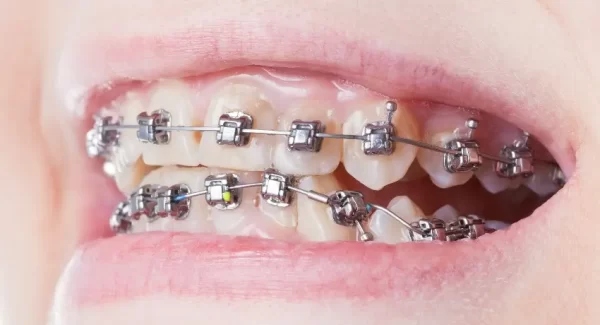 Niềng răng mắc cài tự buộc – Giải pháp niềng răng hiệu quả